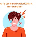 How to Get Rid of Dandruff After A Hair Transplant?