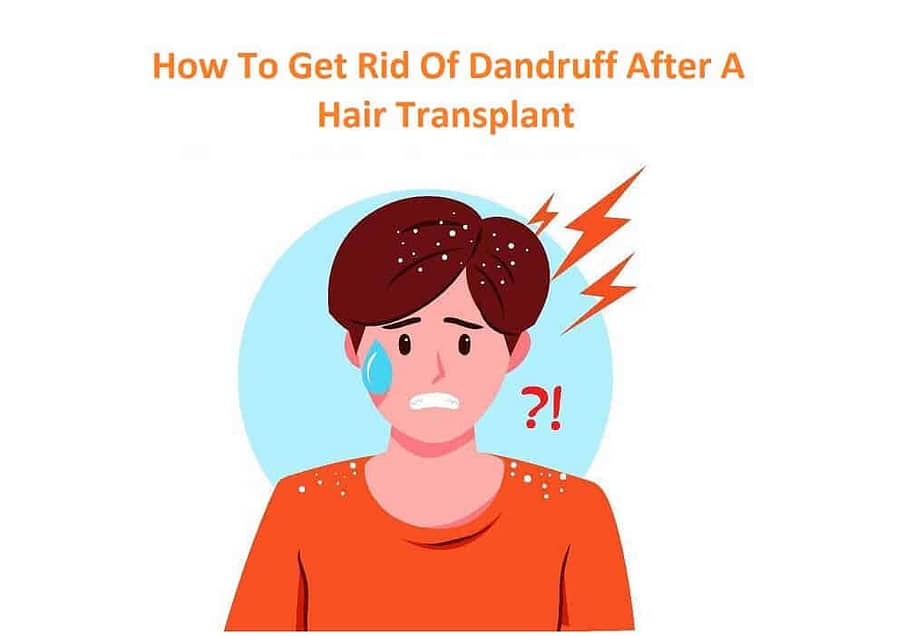 Get Rid of Dandruff After A Hair Transplant
